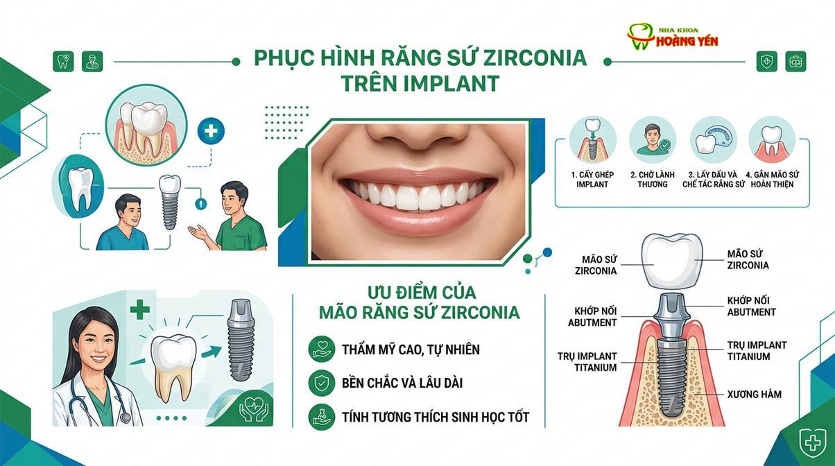 Phục hình răng sứ Zirconia trên Implant mang lại độ thẩm mỹ và khả năng chịu lực ổn định.