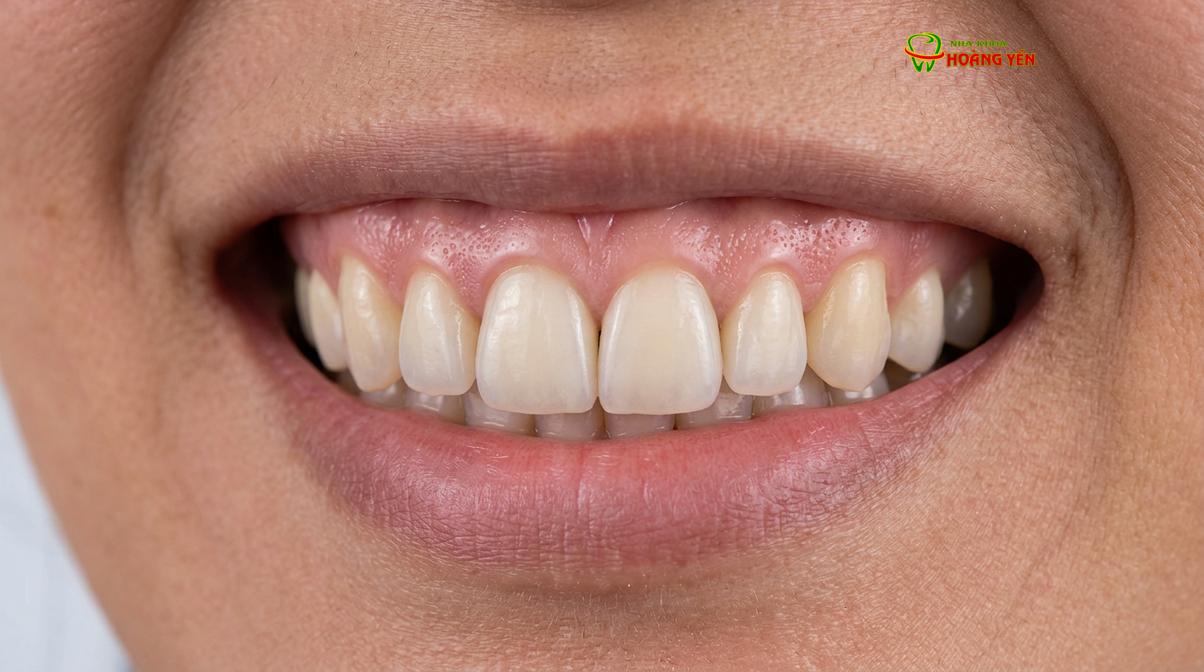 Phục hình răng cửa trên implant thành công không chỉ ở chức năng ăn nhai mà còn phải đạt độ hài hòa về mô nướu.