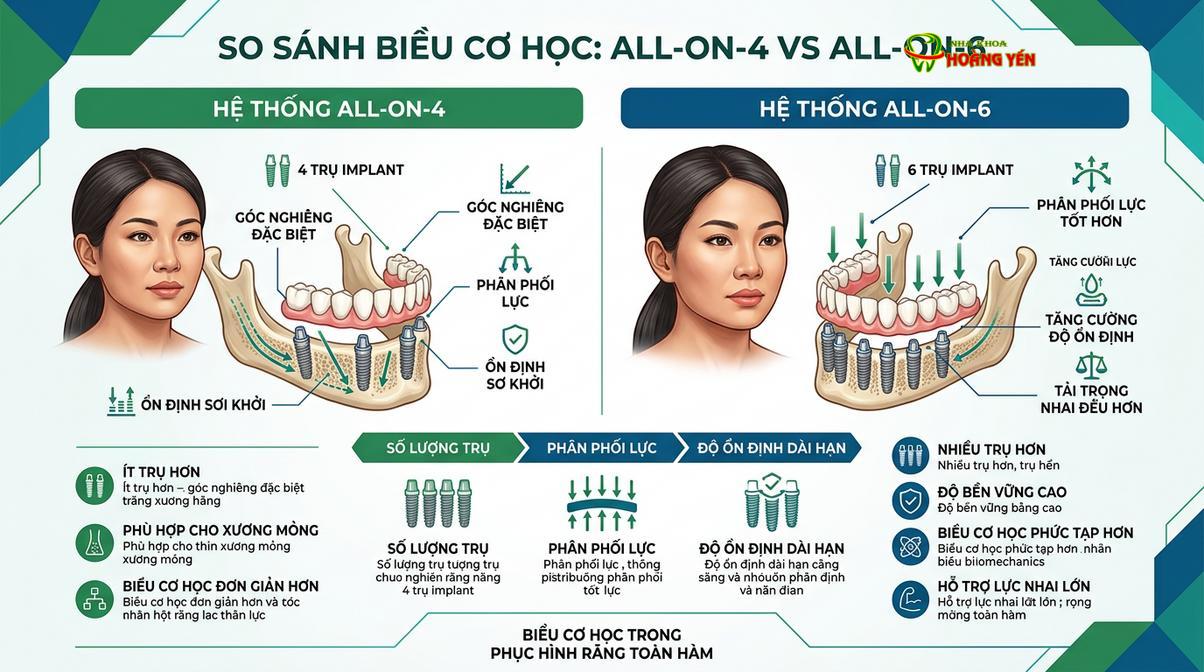 Mô phỏng phân bố lực cơ học trong kỹ thuật phục hình toàn hàm All-on-4 và All-on-6.