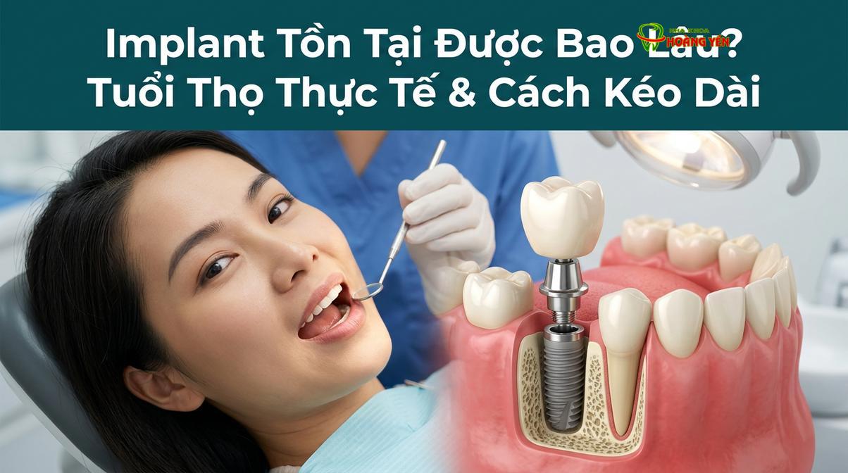 Cấu tạo 3 phần cơ bản của một chiếc răng implant.