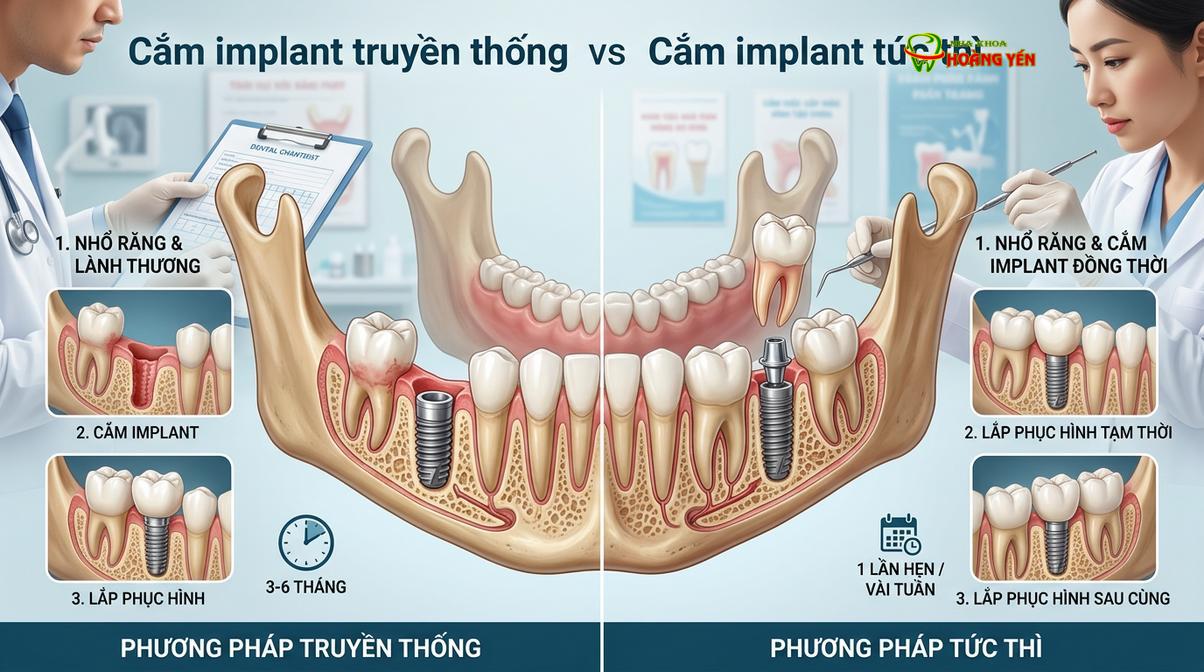 Mô phỏng sự khác biệt giữa quy trình cấy ghép truyền thống và cấy ghép tức thì sau nhổ răng.