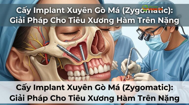Cấy Implant Xuyên Gò Má (Zygomatic): Giải Pháp Cho Tiêu Xương Hàm Trên Nặng