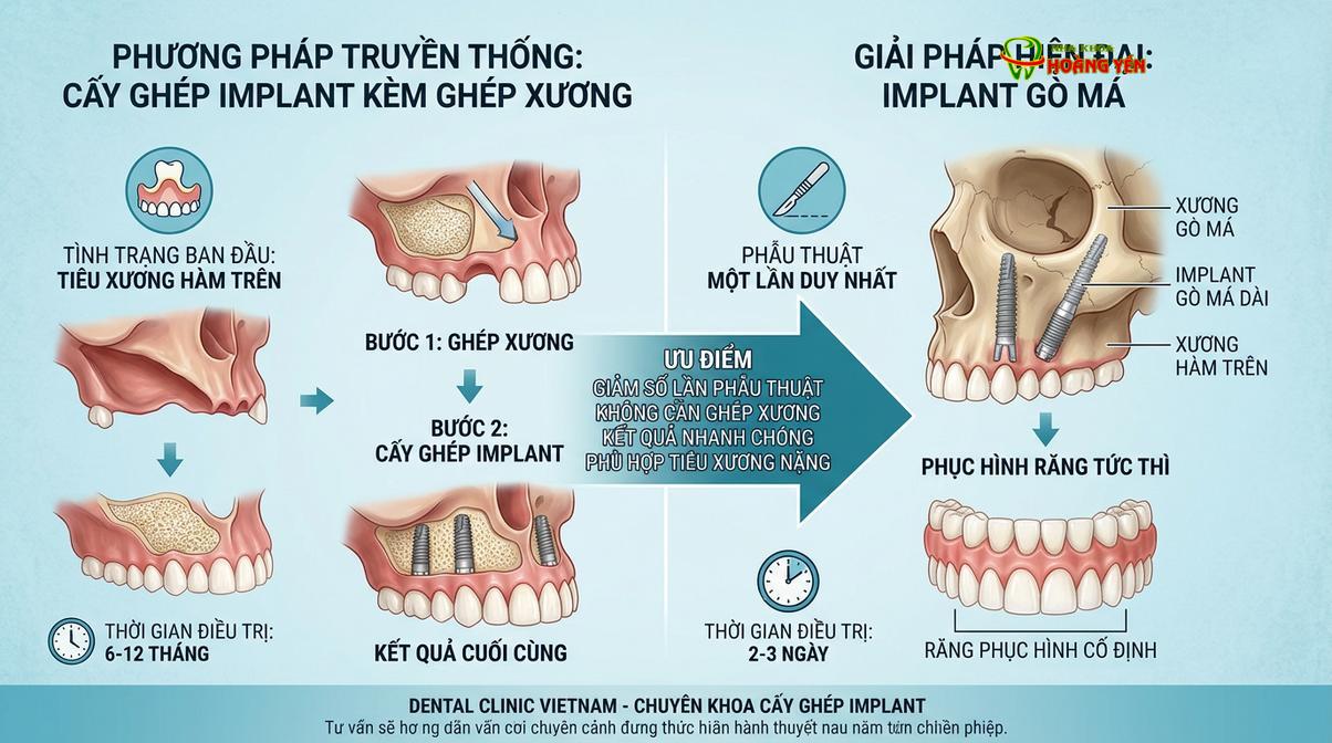 So sánh sự khác biệt cơ bản giữa kỹ thuật cấy ghép implant truyền thống và implant xuyên gò má.