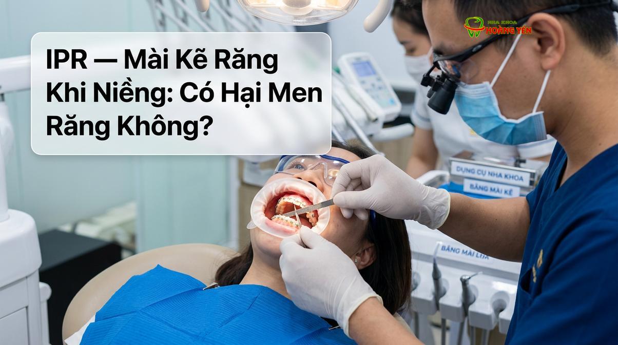 Kỹ thuật mài kẽ răng bằng lá nhám kim cương thủ công giúp bác sĩ kiểm soát lượng men răng được loại bỏ.
