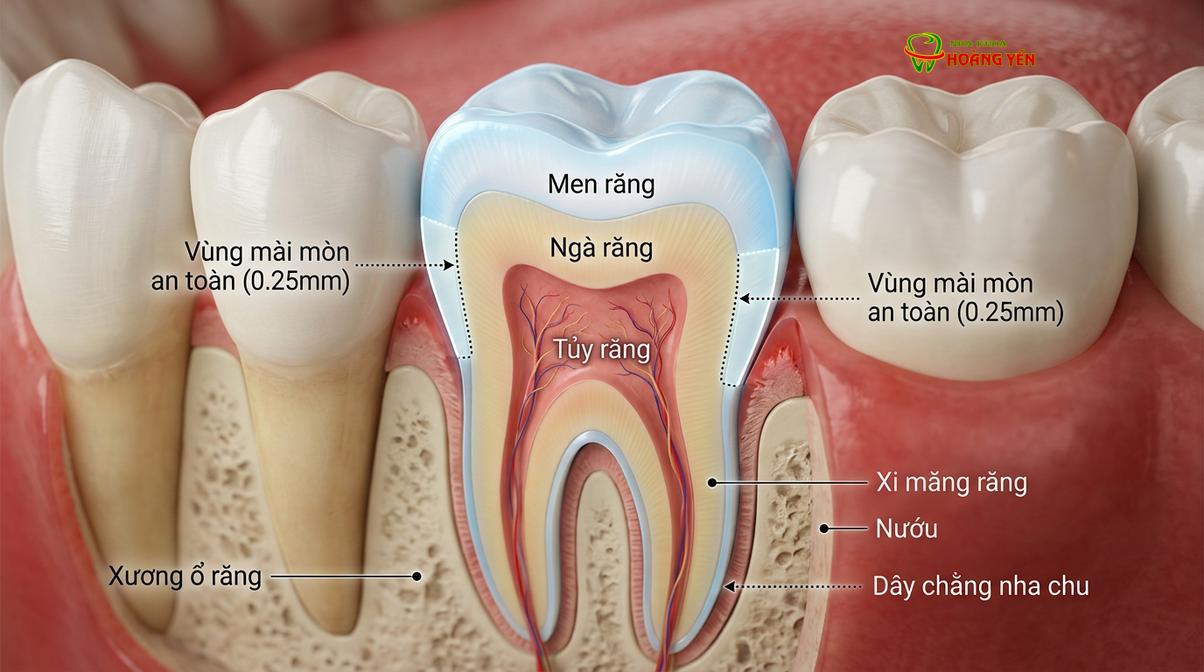 Mô phỏng cấu trúc men răng: Việc mài đi một lớp mỏng ở mặt bên thường nằm trong giới hạn sinh lý an toàn.