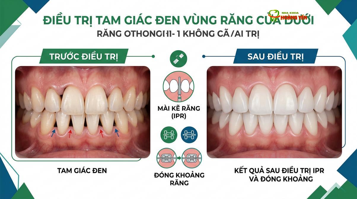 IPR là một trong những giải pháp hỗ trợ cải thiện các tam giác đen vùng răng cửa dưới.