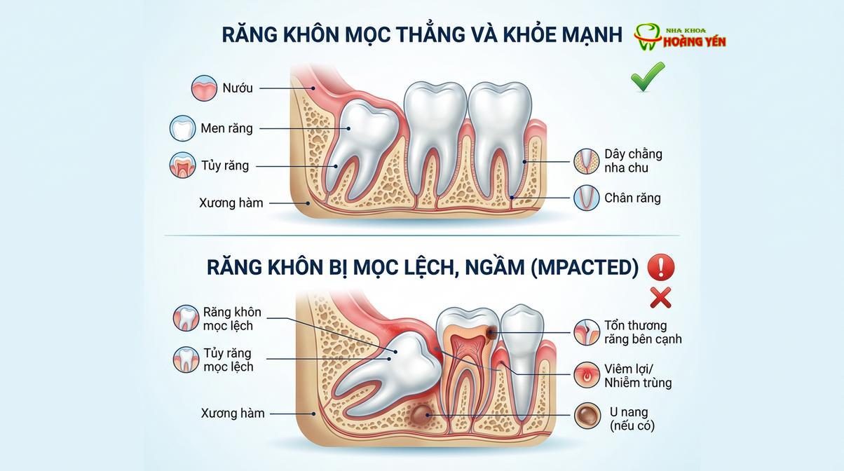 Sự khác biệt giữa răng khôn mọc thẳng an toàn và răng khôn mọc ngầm, mọc lệch gây nguy hiểm.