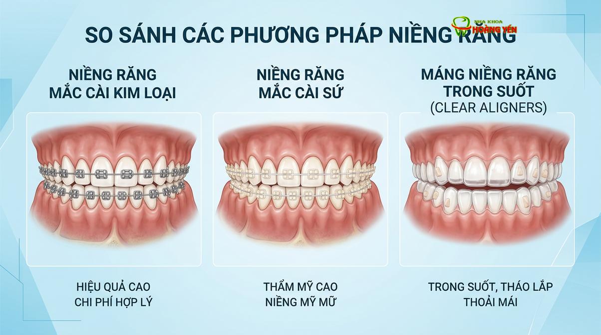 Các phương pháp chỉnh nha phổ biến hiện nay bao gồm mắc cài kim loại, mắc cài sứ và khay trong suốt.