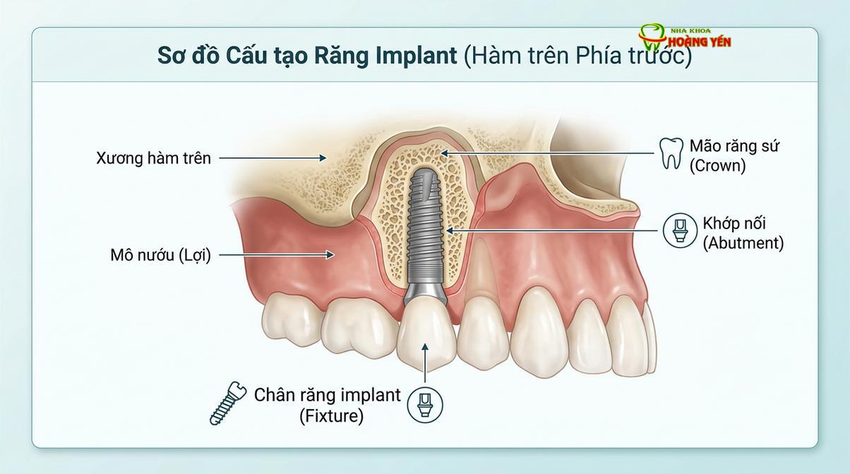 Cấu tạo chi tiết của một chiếc răng implant hoàn chỉnh bao gồm trụ Titanium, khớp nối Abutment và mão răng sứ.
