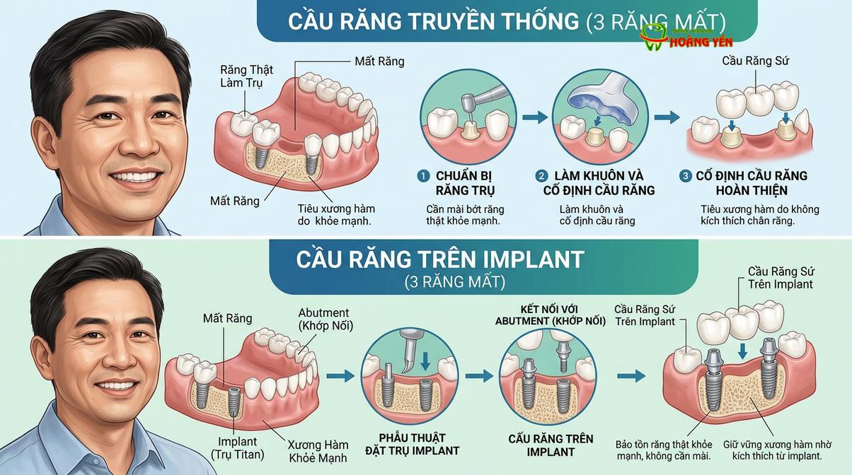 Mô phỏng sự khác biệt giữa cầu răng sứ truyền thống và cầu răng trên implant.