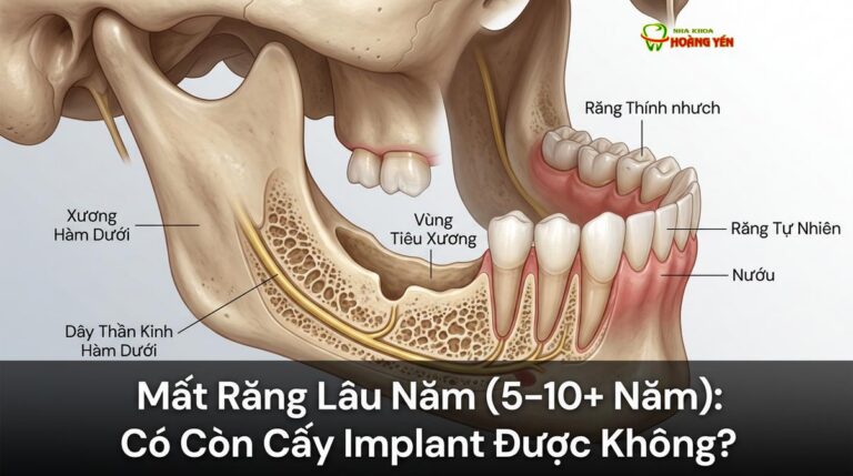 Mất Răng Lâu Năm (5–10+ Năm): Có Còn Cấy Implant Được Không?