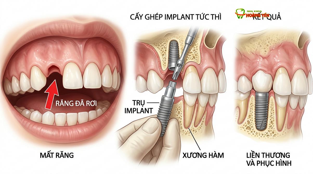 Mô phỏng kỹ thuật cấy ghép implant tức thì vào huyệt ổ răng ngay sau khi nhổ bỏ chân răng tổn thương.