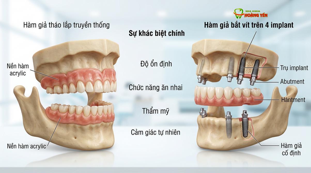 Mô phỏng sự khác biệt giữa hàm giả tháo lắp và phục hình cố định trên implant.