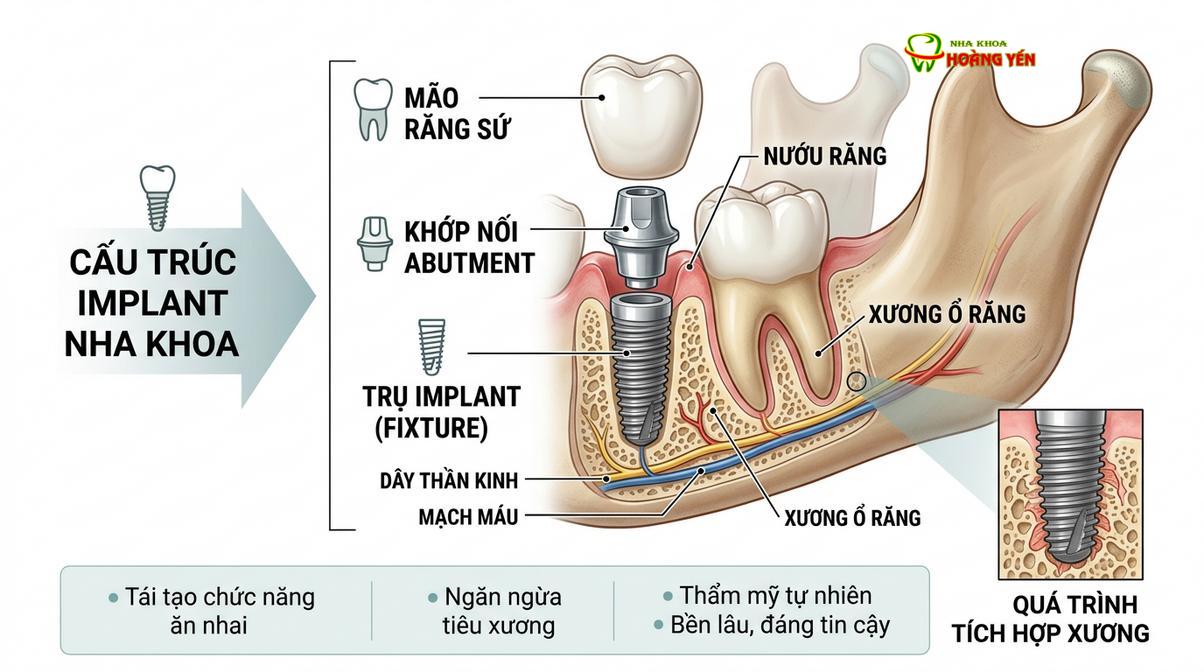 Cấu tạo cơ bản của một chiếc răng implant tiêu chuẩn.