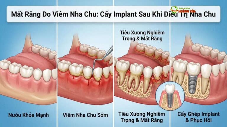 Mất Răng Do Viêm Nha Chu: Cấy Implant Sau Khi Điều Trị Nha Chu