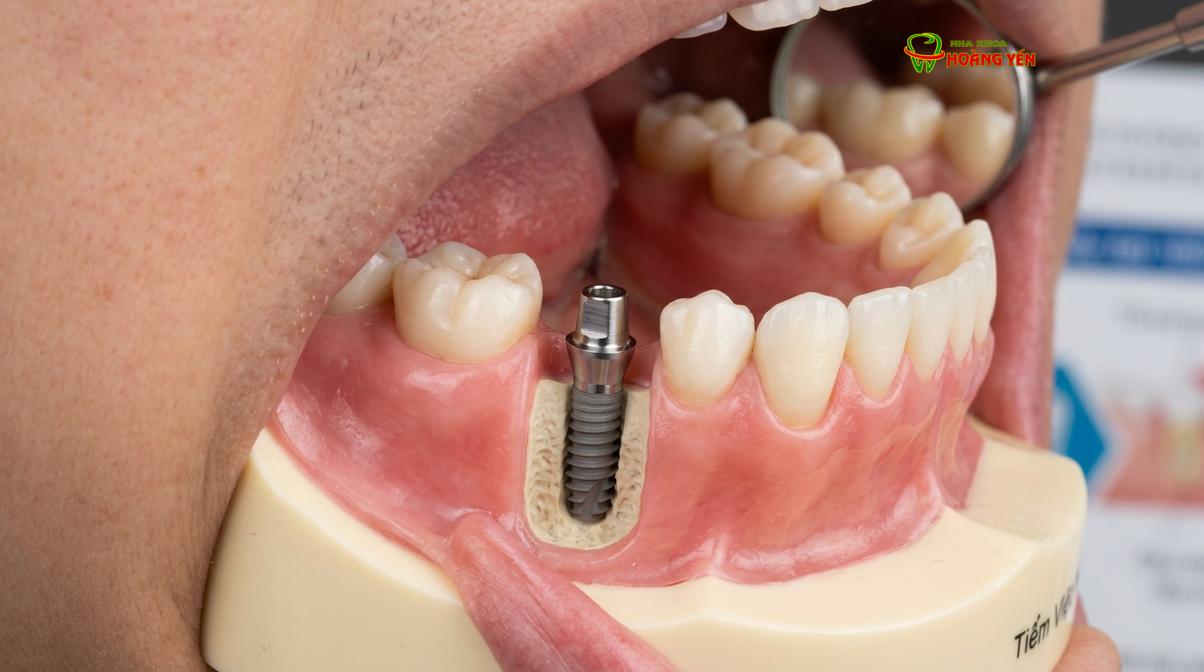 Mô phỏng cấu trúc răng implant được cấy ghép vững chắc vào xương hàm thay thế răng đã mất.