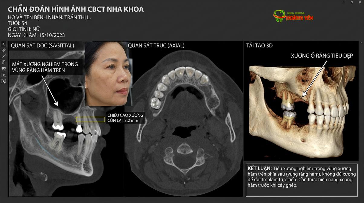 Hình ảnh X-quang CT Cone Beam 3D đánh giá mức độ tiêu xương hàm trên.