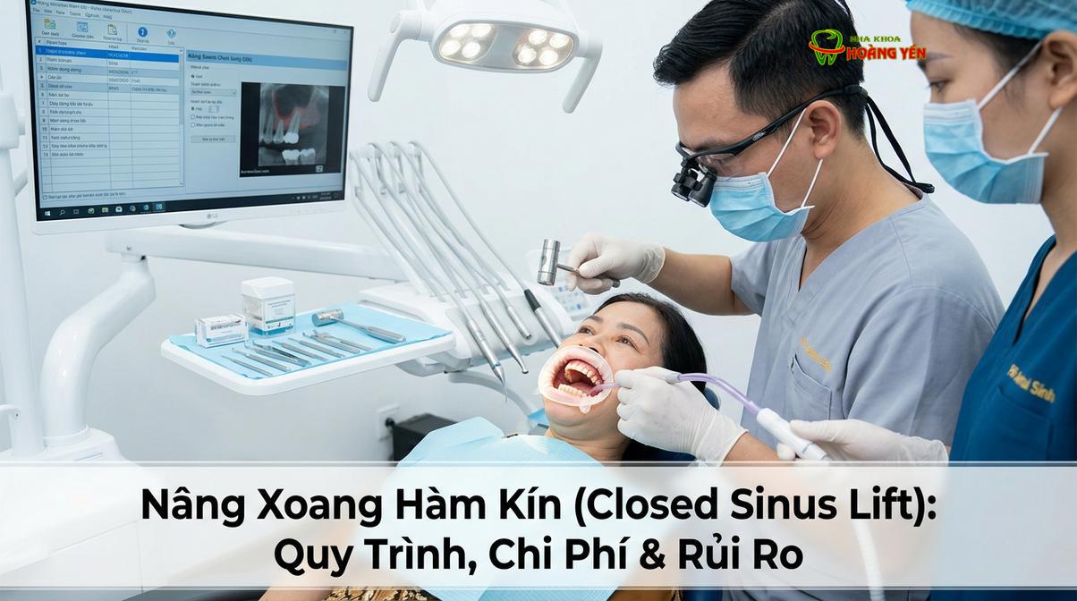 Mô phỏng kỹ thuật nâng xoang nội thông qua vị trí cấy ghép implant.