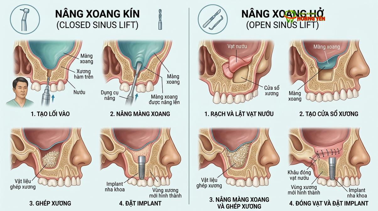Sự khác biệt cơ bản về mức độ can thiệp giữa hai phương pháp nâng xoang.