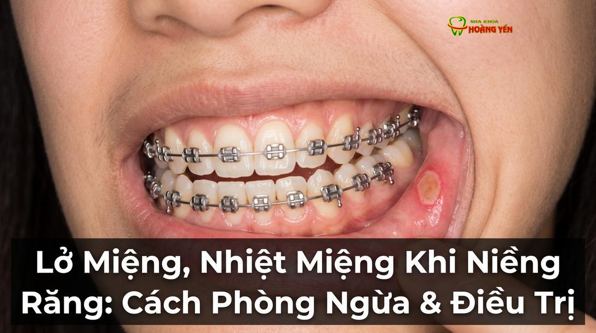 Tổn thương niêm mạc má do sự cọ xát liên tục của khí cụ chỉnh nha trong những tuần đầu tiên.
