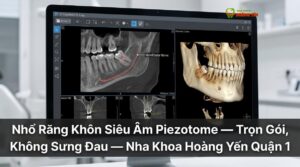 Nhổ Răng Khôn Siêu Âm Piezotome — Trọn Gói, Không Sưng Đau — Nha Khoa Hoàng Yến Quận 1