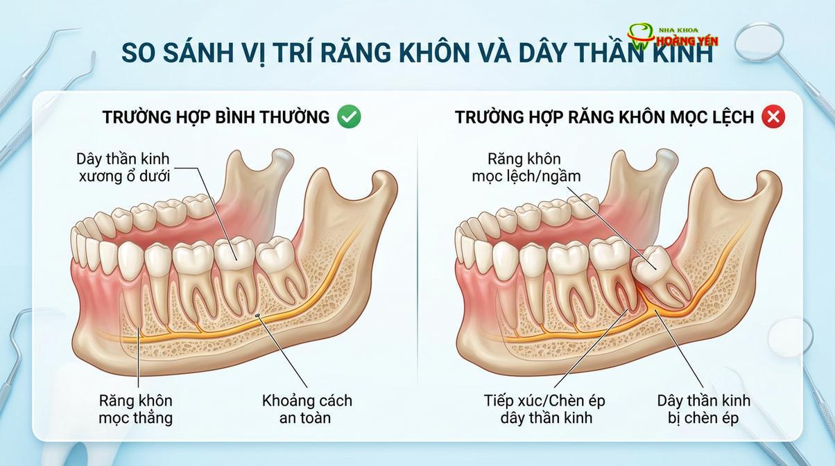 Sự chèn ép của răng khôn mọc lệch ngầm lên hệ thống thần kinh và răng lân cận.