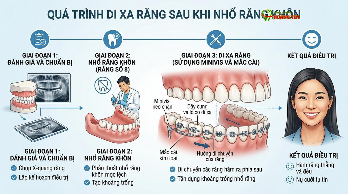 Sơ đồ minh họa quá trình di xa (kéo lùi răng) vào khoảng trống sau khi đã nhổ bỏ răng khôn.