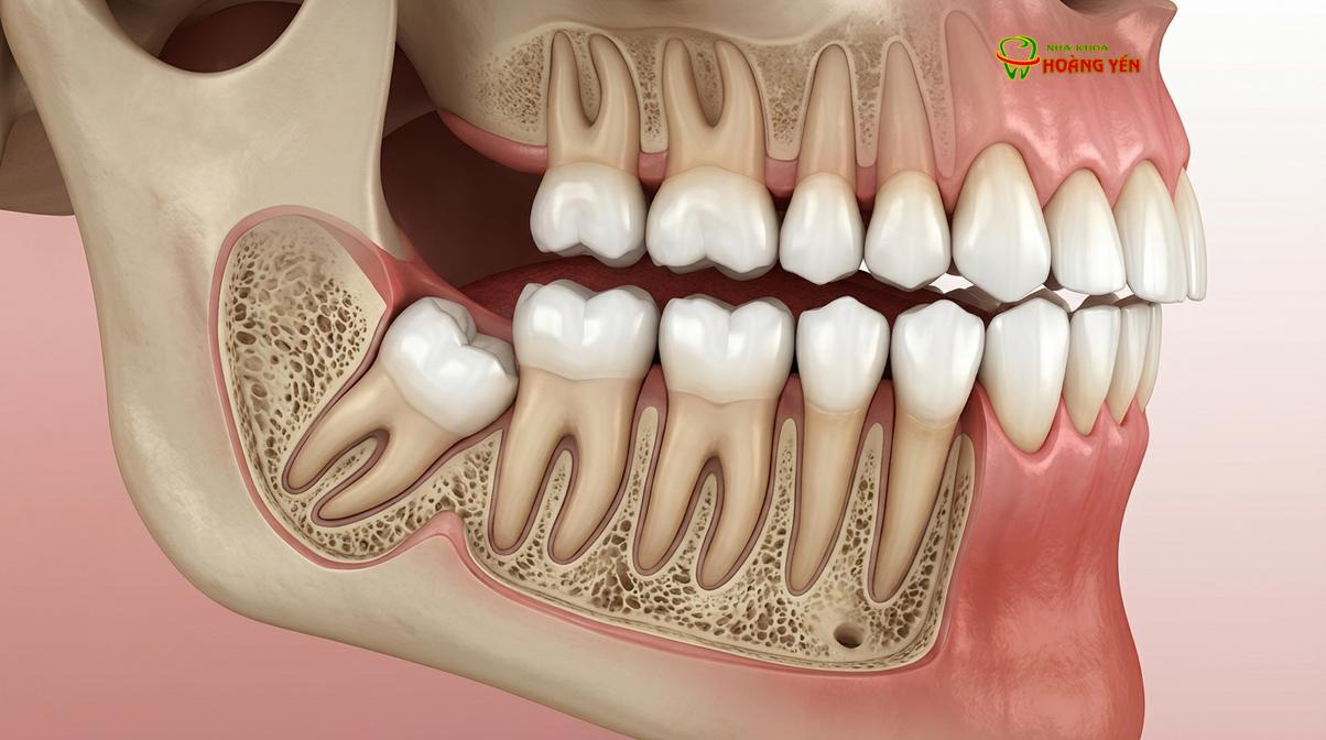 Răng khôn mọc ngầm, mọc lệch đâm ngang là nguyên nhân chính gây áp lực lên răng số 7 và toàn bộ cung hàm.