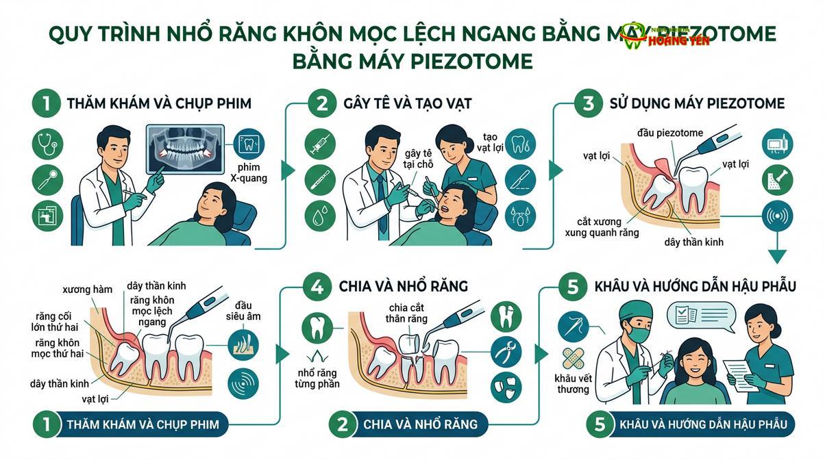 Mô phỏng quá trình bóc tách và chia cắt thân răng khôn mọc ngầm bằng sóng siêu âm.