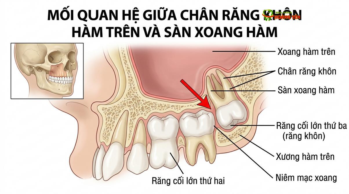 Răng khôn hàm trên có vị trí giải phẫu nằm sát đáy xoang hàm, đòi hỏi kỹ thuật nhổ khéo léo để tránh tổn thương màng xoang.