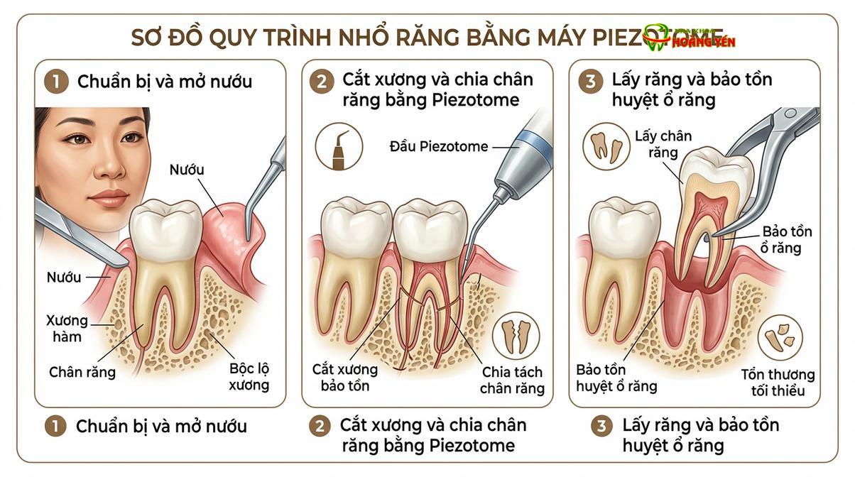 Công nghệ siêu âm Piezotome giúp cắt đứt dây chằng nha chu nhẹ nhàng, bảo tồn tối đa xương ổ răng trong quy trình phẫu thuật.