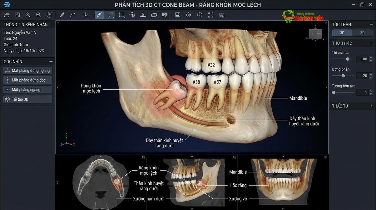 Phim chụp CT Cone Beam 3D giúp bác sĩ khảo sát vị trí chân răng và dây thần kinh.