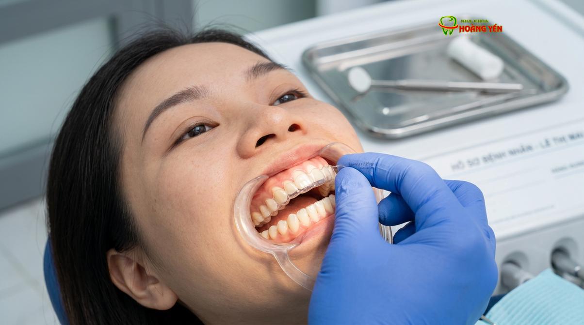 Khay niềng trong suốt là một trong những lựa chọn thẩm mỹ cao cho các ca chỉnh nha đơn hàm.