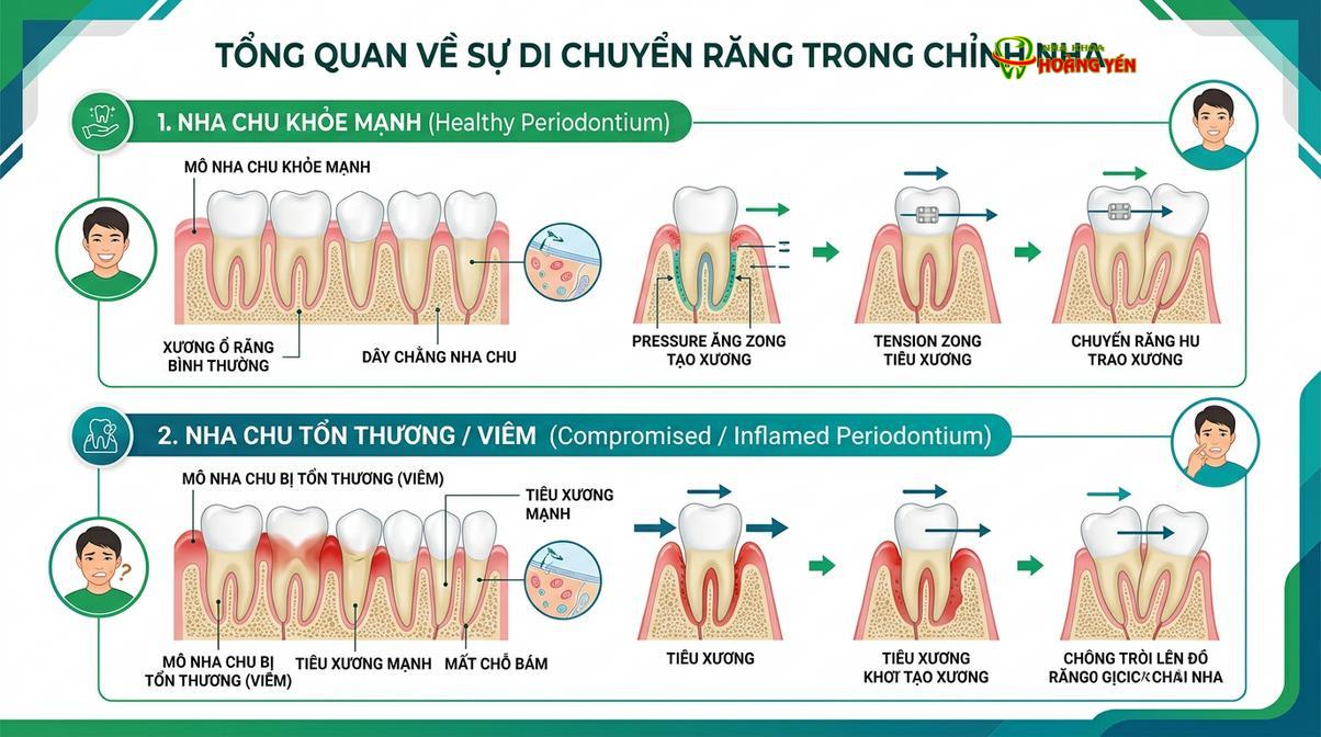 Sự di chuyển của răng đòi hỏi mô nâng đỡ (xương ổ răng, dây chằng) phải trong trạng thái khỏe mạnh và không viêm nhiễm.
