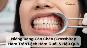 Niềng Răng Cắn Chéo (Crossbite): Hàm Trên Lệch Hàm Dưới & Hậu Quả