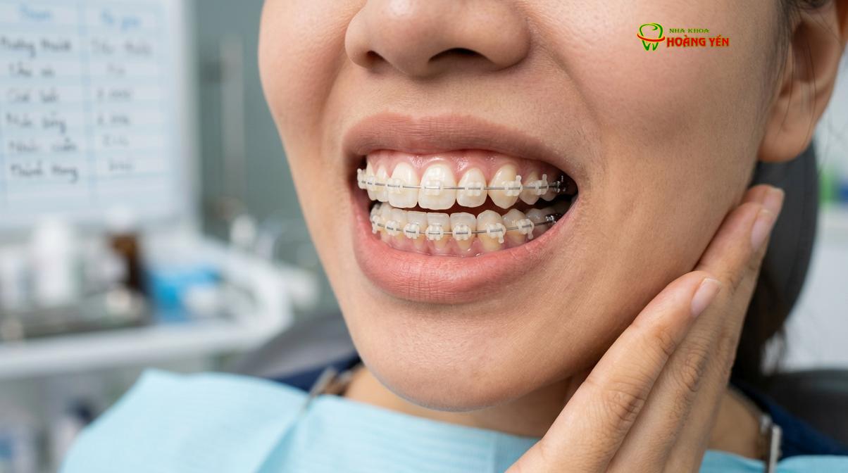 Sử dụng mắc cài sứ là một trong những giải pháp thẩm mỹ giúp khắc phục cắn chéo hiệu quả.