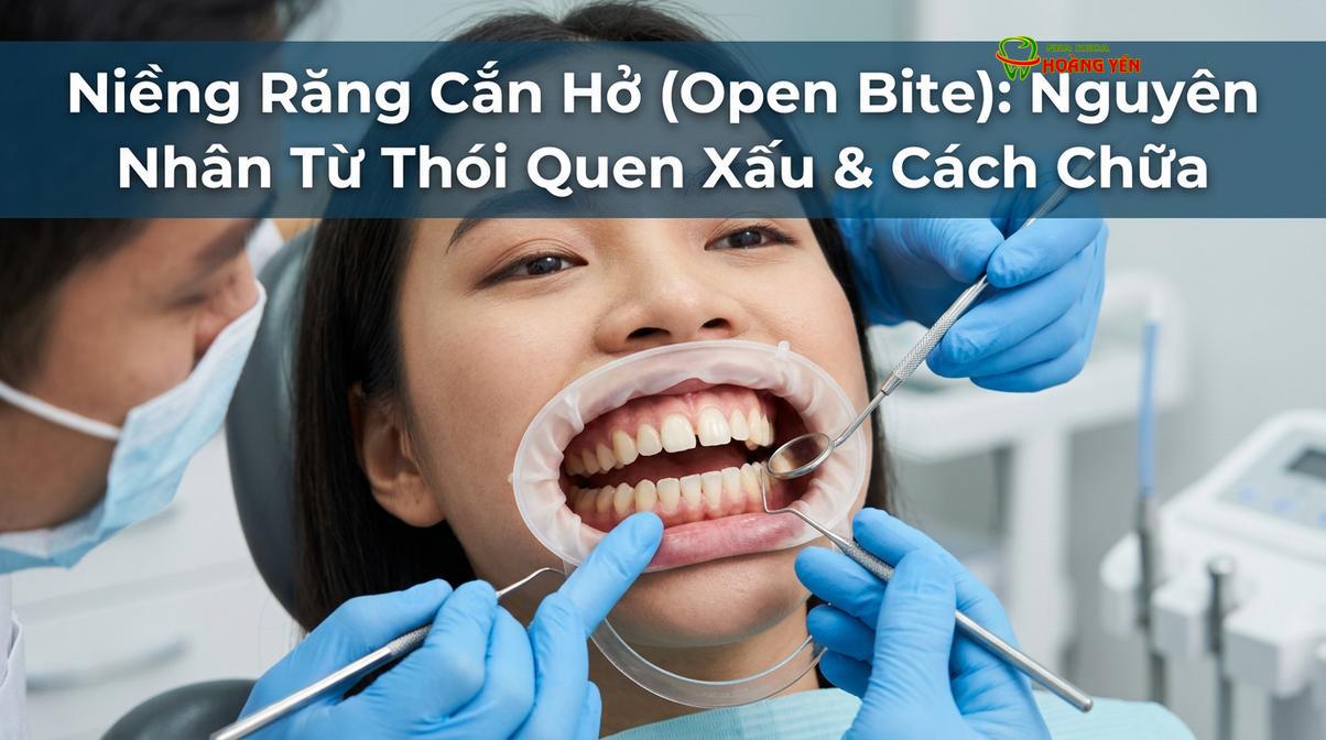 Tình trạng khớp cắn hở phía trước khiến các răng cửa không thể chạm nhau khi cắn chặt hai hàm.