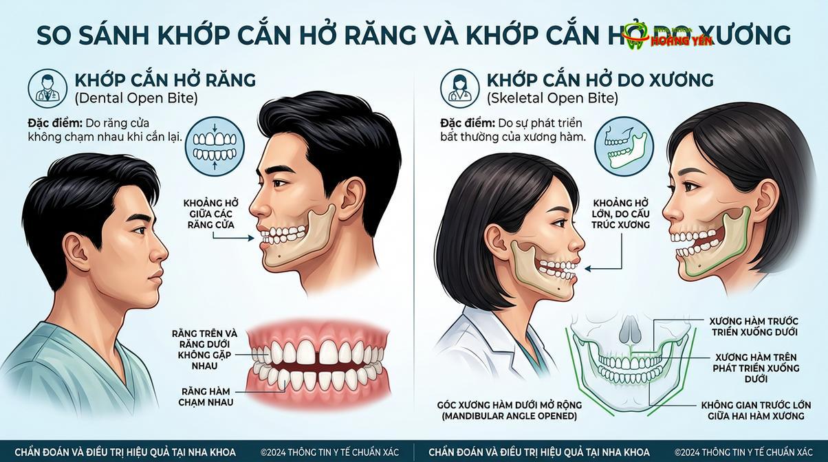 Phân biệt giữa cắn hở do răng (thường do thói quen xấu) và cắn hở do xương (do cấu trúc xương hàm phát triển sai lệch).