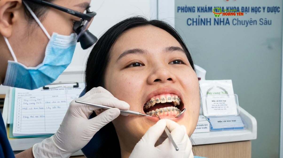 Niềng răng mắc cài là phương pháp truyền thống mang lại hiệu quả cao trong việc dàn đều răng.