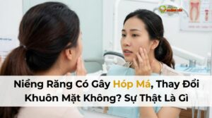 Visual illustration of niềng răng hóp má