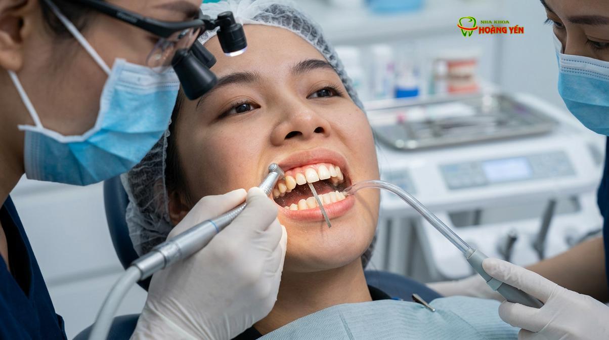 Kỹ thuật mài kẽ răng (IPR) giúp tạo khoảng trống an toàn mà không cần nhổ răng.