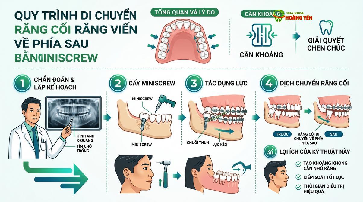 Sử dụng Miniscrew để kéo lùi toàn bộ hàm về phía sau, giải quyết tình trạng hô nhẹ.