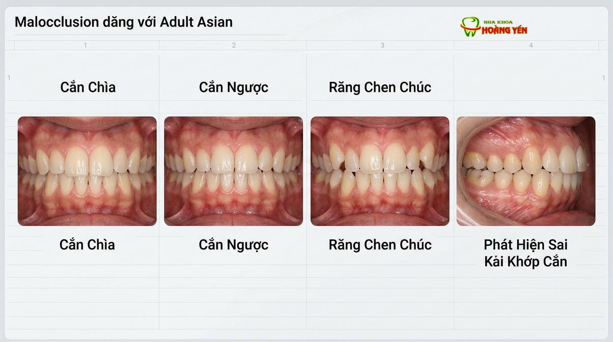 Niềng răng thẩm mỹ giúp bệnh nhân tự tin ngay cả trong quá trình điều trị
