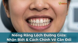 Niềng Răng Lệch Đường Giữa: Nhận Biết & Cách Chỉnh Về Cân Đối