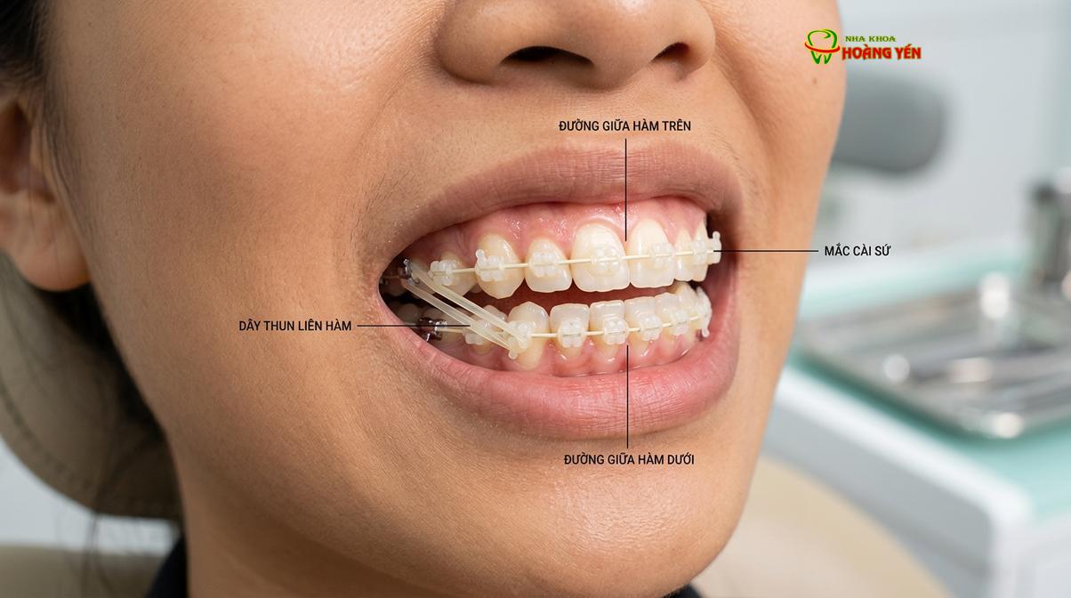 Sử dụng thun liên hàm trong chỉnh nha là kỹ thuật phổ biến để kéo đường giữa về đúng vị trí.