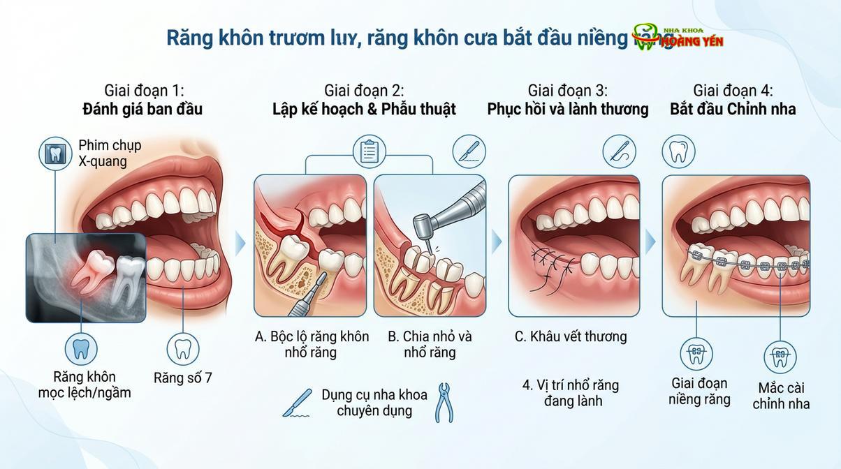 Nhổ răng khôn mọc ngầm là chỉ định lâm sàng phổ biến để tạo khoảng trống cho răng dịch chuyển.