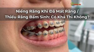 Visual illustration of niềng răng mất răng