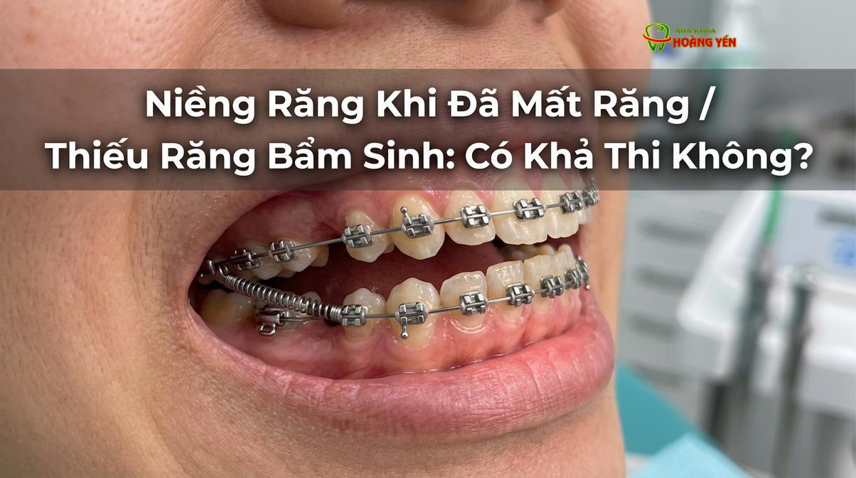 Khí cụ chỉnh nha đang thực hiện quá trình đóng khoảng tại vị trí răng bị mất.