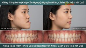 Niềng Răng Móm (Khớp Cắn Ngược): Nguyên Nhân, Cách Điều Trị & Kết Quả