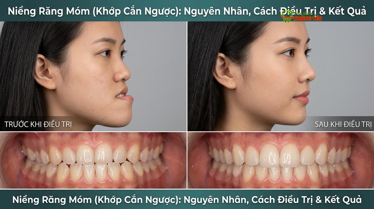 Sự thay đổi thẩm mỹ khuôn mặt nghiêng trước và sau khi điều trị khớp cắn ngược.